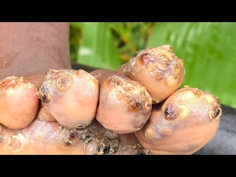 Kevin Ayua's many jiggers pulled out #2 - see long videos @ riseupsociety.net & ruskenya.org