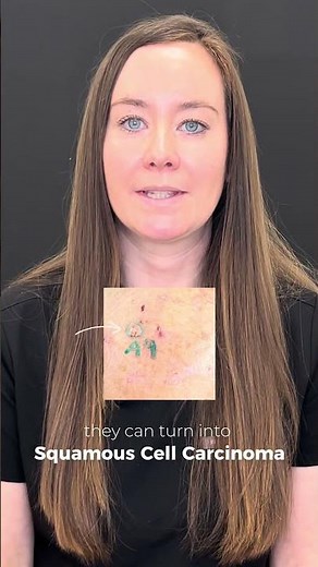 How to Spot Early Warning Signs of Skin Cancer Before Its Too Late