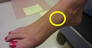 How can you quickly recover from a navicular stress fracture? | Dr Geier