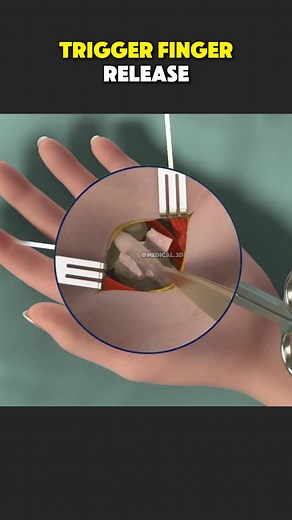 Trigger Finger Release Surgery (3D Animation) #triggerfinger #triggerfingerrelease #triggerfingersurgery #fingersurgery #triggerfinger?