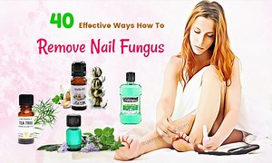 40 Effective Ways How To Remove Nail Fungus Fast At Home