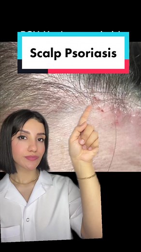 Effective Solutions for Scalp Psoriasis: Shampoos and Lotions