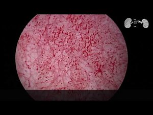 cystite interstitielle / clinique saint Jean sud de France