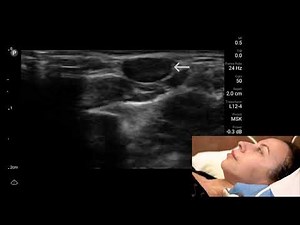 Botulinum Toxin Injections - Part 2