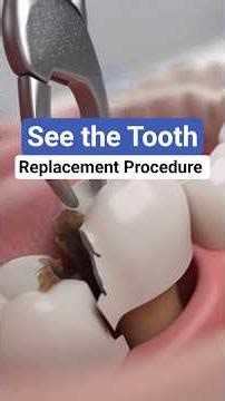 Dental Implant 3D | Ultra Realistic Tooth Replacement Animation #3danimation #dentalimplants