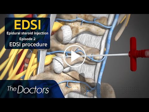 The Doctors Epidural Steroid Injection (EDSI) procedure