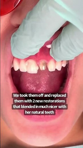 2 front teeth | porcelain crowns | dental crowns before and after | Dr. Yazdan | smile makeover