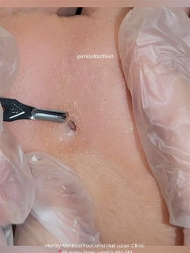 Deep corn removal… in progress 👣😬by Miss Foot Fixer Marion Yau Layer by layer until relief. Want the full satisfying removal? 👀 👉 Watch here: https://www.youtube.com/watch?v=8gWzC_lbEoI #deepcorn #cornremoval #footcare #podiatry #satisfying #asmr #relief #medical #foryoupage #fyp