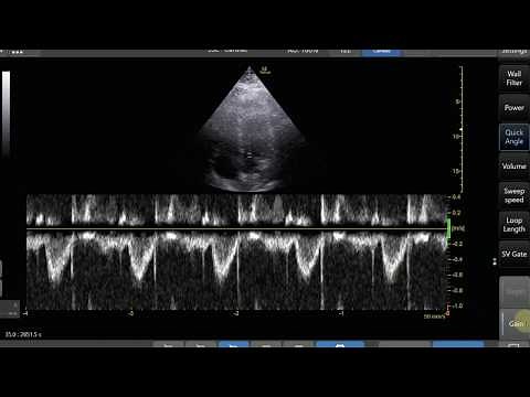 Pulse Wave Doppler Step by Step - LVOT VTI Example