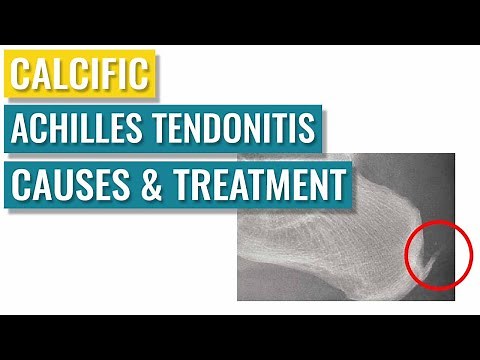 Calcific Achilles Tendonitis Treatment & Causes