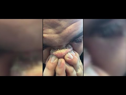DIY Blackhead Removal Goes Viral
