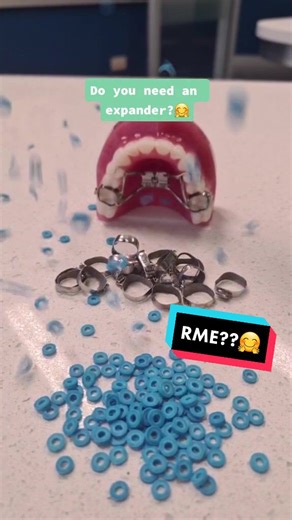 Orthodontic Expander Process: How To Get Your Expander On