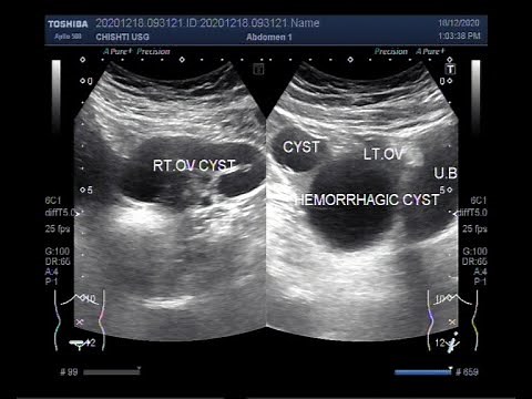Ultrasound Video showing Ovarian Cysts, simple, Hemorrhagic and complex ones, all in one patient.