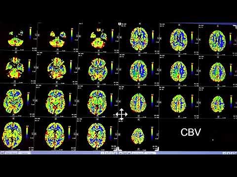 Video 2 of 3: How to Interpret a Brain CT Perfusion Scan for acute stroke