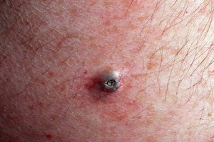 3 Steps to Deal With Dilated Pore of Winer