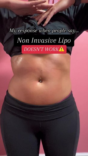 Non invasive body contouring is a safe and effective, result proving alternative to surgery. #bodycontouring #noninvasivebodycontouring #bblorbodycontouring