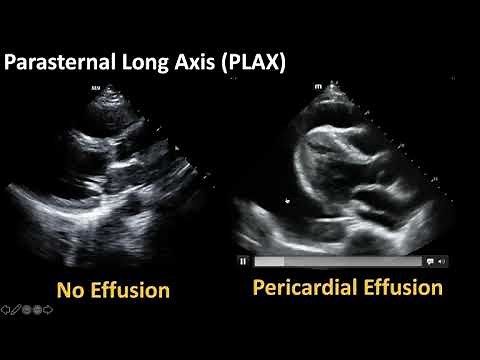 Cardiac Ultrasound: Basic Pathology