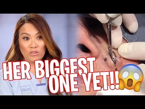 The BIGGEST Blackheads Extractions on Dr. Pimple Popper! (2020)