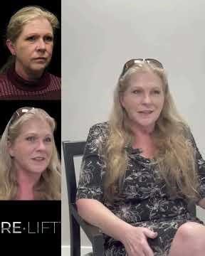 My First Plastic Surgery Failed... Here’s How I Fixed It (No General Anesthesia)