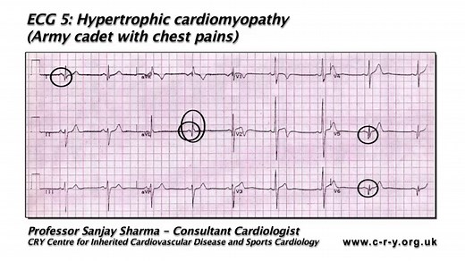 Hypertrophic Cardiomyopathy (HCM)