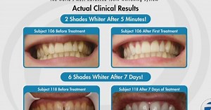 Power Swabs Teeth Whitening