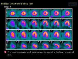 Nuclear stress test