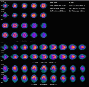 Myocardial perfusion imaging - Alchetron, the free social encyclopedia