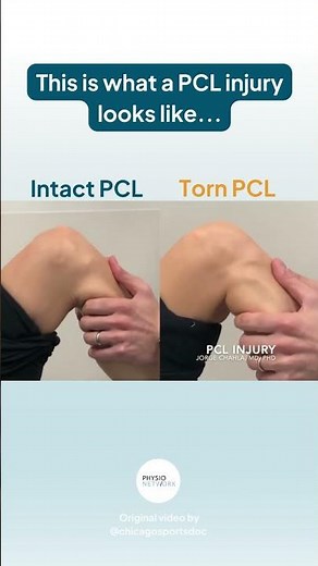 This Is What An Injured PCL Looks Like!