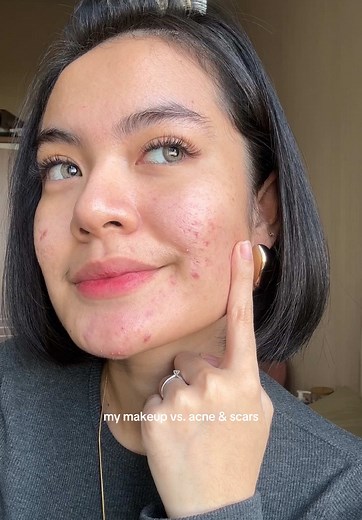 Makeup Tips to Cover Acne and Scars Effectively
