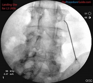 Fluoroscopic Guided Thoracic/Lumbar Medial Branch Radiofrequency Ablation - Technique and Overview - The Procedure Guide