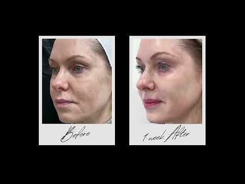 Laser Skin Resurfacing