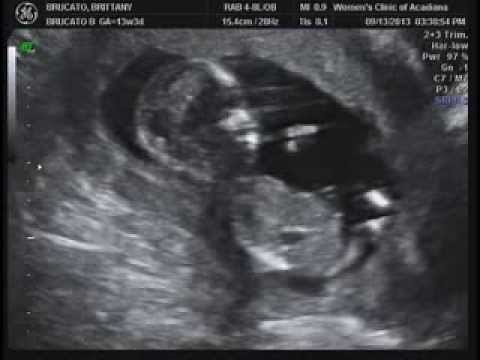 2D/4D Ultrasound 13 Weeks 3 Days and Gender!