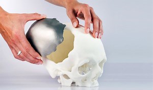3D Printed Medical Implants: Discover Some of the Most Innovative Projects - 3Dnatives