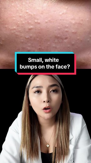 Understanding White Bumps on the Face | Expert Skin Care Advice