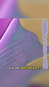 How Deviated Septum Surgery (Septoplasty) Helps You Breath Better?... (3D Animation) #How #deviatedseptum #septum #surgery #help #breath #doctor #anesthesia #airflow #nose #septoplasty #NasalHealth #health #NasalBreathing #medical3danimation #3dmedicalanimation | Medcare777