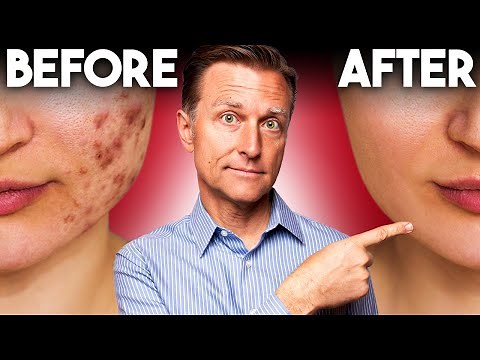 The FASTEST Way to Rid Acne - Dr. Berg