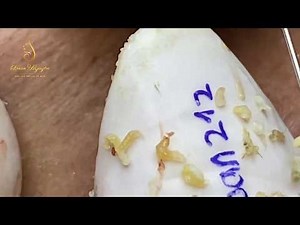 ACNE TREATMENT BLACKHEADS (212) | Loan Nguyen