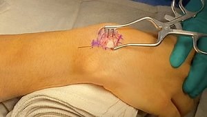 Two-Screw Scaphoid Fixation for Proximal Pole Fractures