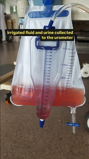 Bladder irrigation | Post TURP clot removal #anatomy #procedures #medical #hospital
