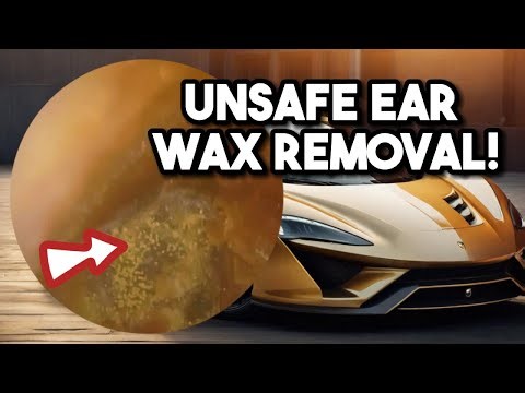 Is This the Most Difficult Ear Wax Removal Ever?