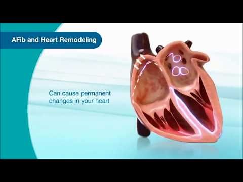 What is Atrial Fibrillation (AFib)? This Video Explains It