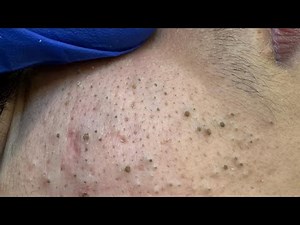 Aggressive Blackhead Extraction ASMR — Pimple Popping & Facial Care