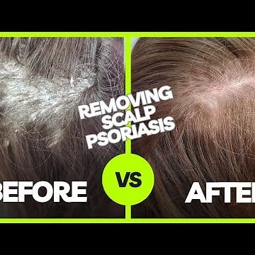 Removing Plaque Scalp Psoriasis | Using The Anti-Fungal Bundle myhappyscalp.com