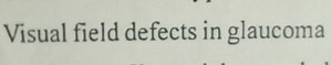 Visual field defects in glaucoma... | Filo