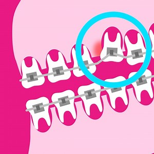 1.2M views · 9.8K reactions | This is how braces actually work. | Insider Science | Facebook