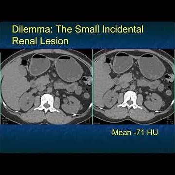 Dilemma: The Small Incidental Renal Lesion
