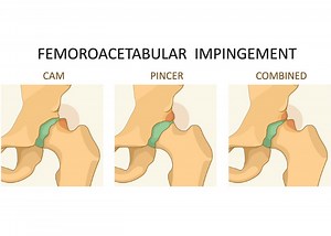 Femoroacetabular Impingement Treatment | FAI Treatment