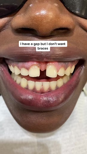 Teeth Composite Bonding for Gap Closure & Reshaping | Maison Dental