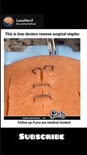 This Is How Doctors Remove Surgical Staples | Medical Procedure Explained#doctor #treatment
