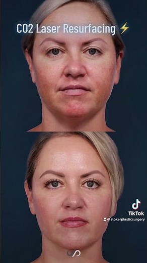 Revitalize Your Skin with CO2 Laser Resurfacing | The Ultimate Solution for Wrinkles and Scars